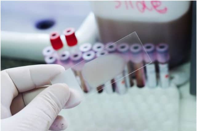 Sickle cell disease is the name for a group of inherited health conditions that affect the red blood cells (Photo: Shutterstock)