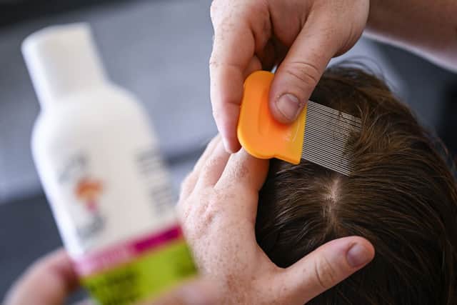 Head lice cases tend to spike when children return to school.
