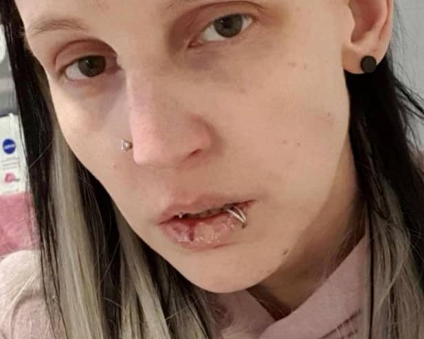 Amylee Pincott, 33, after suffering with ill health due to mould.