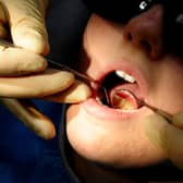 There were almost a dozen hospital admissions in Mansfield to remove children's decaying teeth last year