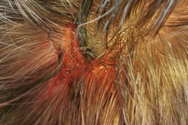 The injury needed gluing by a doctor.