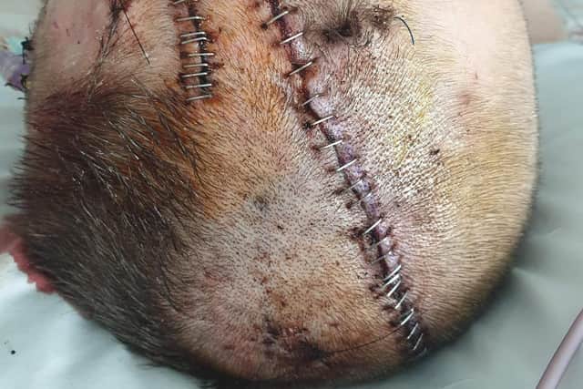 Branden Stromberg during his treatment in hospital.