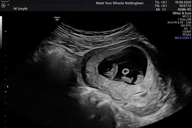 Ultrasound scan of Megan Smyth's triplets. Picture by Megan Smyth / SWNS
