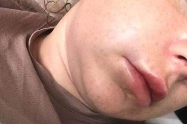 Reanne with her injured cheek
