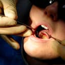 One in nine year 6 children in Broxtowe reported having tooth decay last year