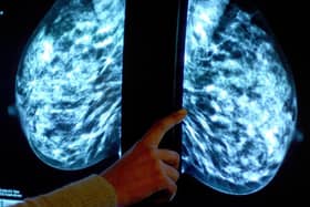 The NHS breast screening programme sees women aged 50-71 invited every three years to undergo a mammogram.