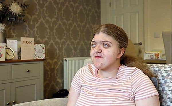 Brave teenager Georgia Carlin was born with Craniosynostosis Syndrome, a condition where the bones that make up your skull fuse too soon.