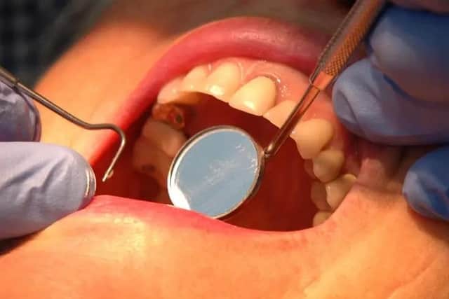 Nationally, 22,549 tooth extractions were completed in 2020-21 – a 58 per cent decrease from 55,137 the year prior.