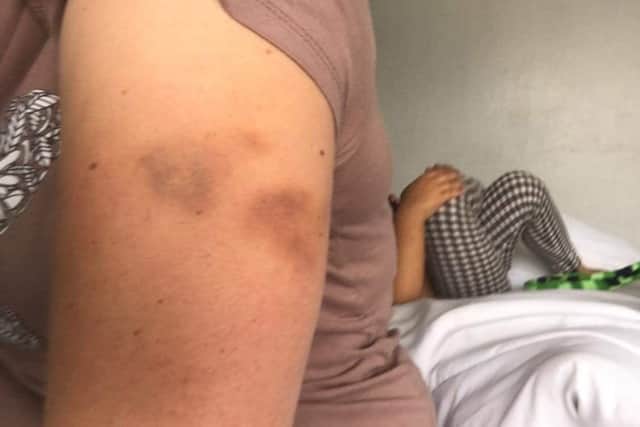 Reanne with her bruised arm