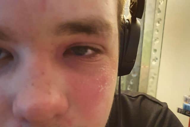 Ashley Hayward's sore eye.