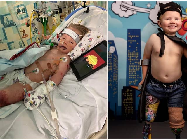 (Left) William was poorly in hospital for over three months (Right) The courageous youngster is learning to walk again- photo by Dinky Feet.