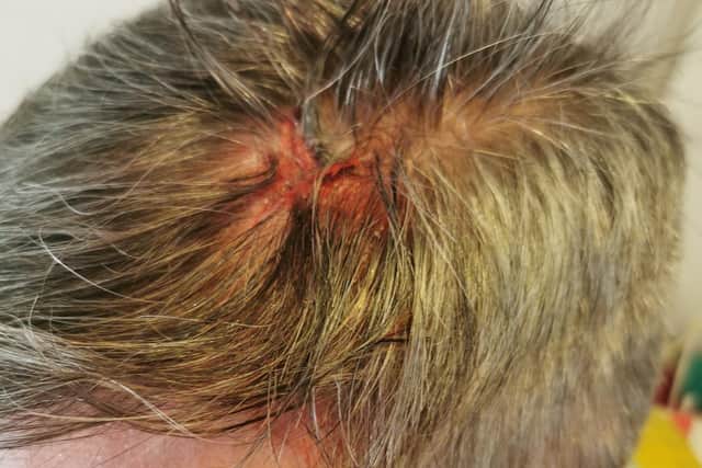 Adam sustained a head injury after being tripped over by an audience member.