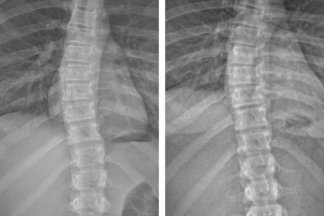 A before and after comparison shows Olivia's spine before and after wearing her brace.