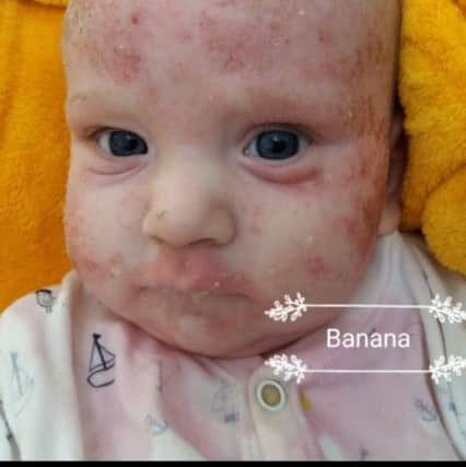 Riley's skin after a reaction to a banana, as documented by mother Kayleigh.