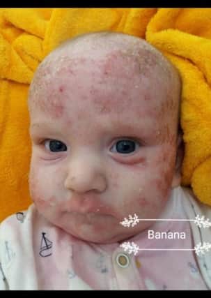 Riley's skin after a reaction to a banana, as documented by mother Kayleigh.