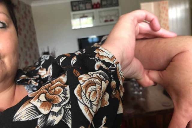 Leah is also hypermobile, a symptom of EDS (PA REAL LIFE/Leah Johnson)