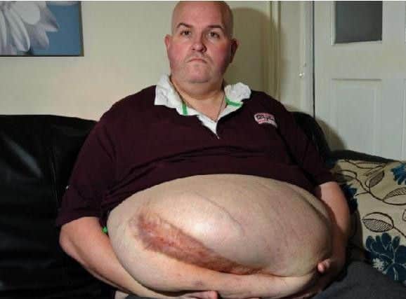 Dean Carron with his hernia.