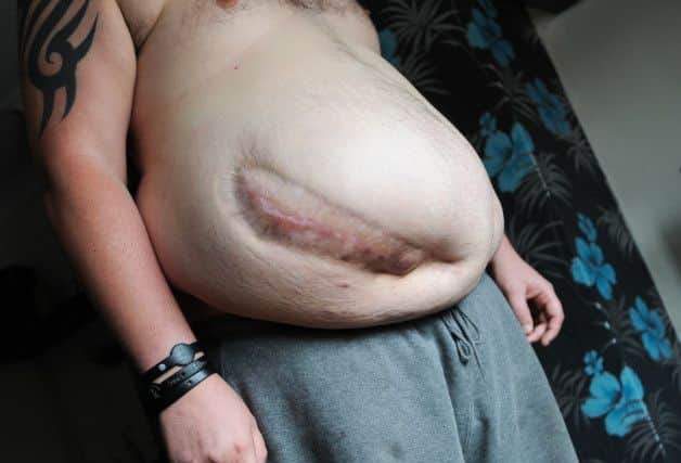 Dean Carron, 38  is taking up a challenge to lose 35 pounds in 90 days.He needs to lose the weight for him to be able to have an operation to remove a huge hernia he developed following an appendix operation.He is doing the challenge along with his friend  from Wales