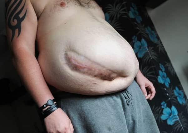 Dean Carron, 38  is taking up a challenge to lose 35 pounds in 90 days.
He needs to lose the weight for him to be able to have an operation to remove a huge hernia he developed following an appendix operation.
He is doing the challenge along with his friend  from Wales