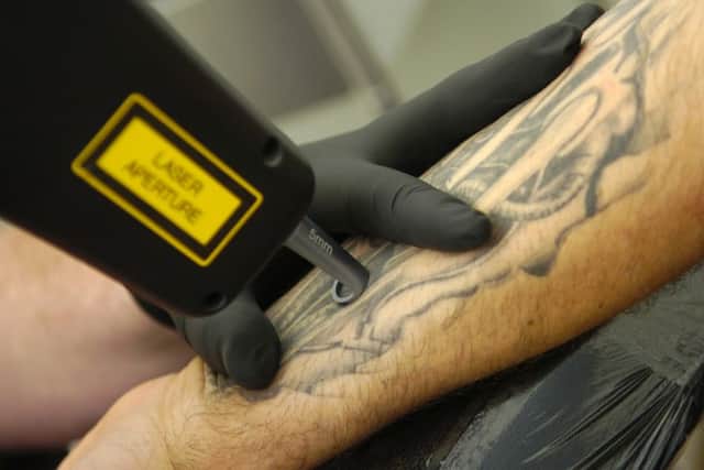 Tattoo removal