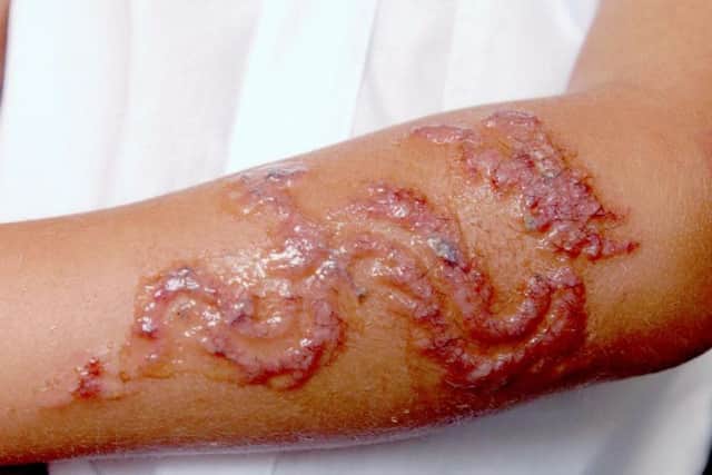 Black henna warning as the summer approaches