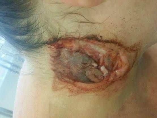 Image shows the wound Suzanne sustained, taken soon after the attack.