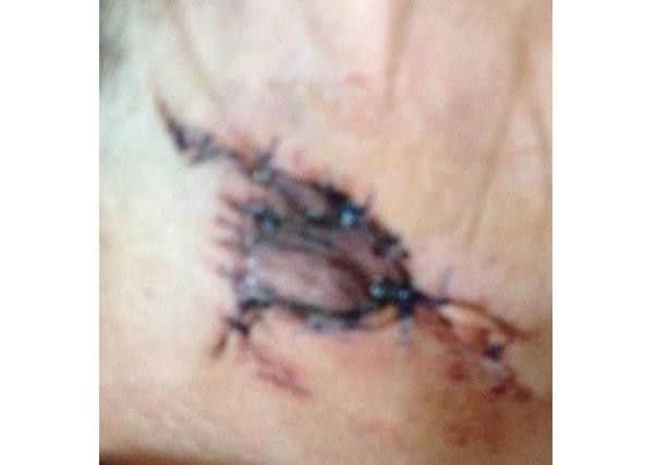 Suzanne's neck after she received an operation at Nottingham City Hospital to close the wound.