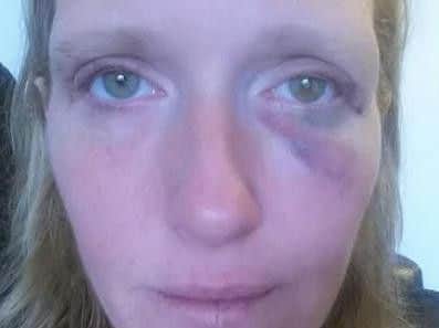 Louise after the attack . Picture submitted.