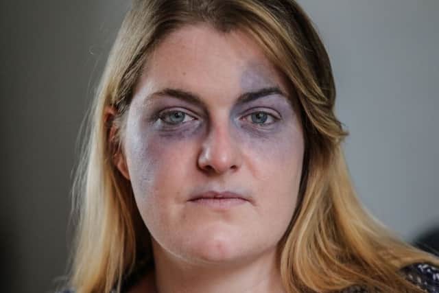 Adele Uden's face is covered with bruises because of a mystery illness. Photo - SWNS.