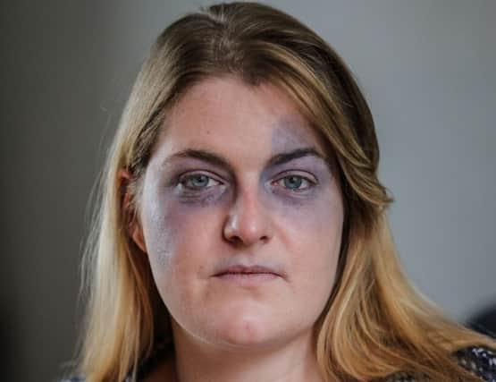 Adele Uden's face is covered with bruises because of a mystery illness. Photo - SWNS.