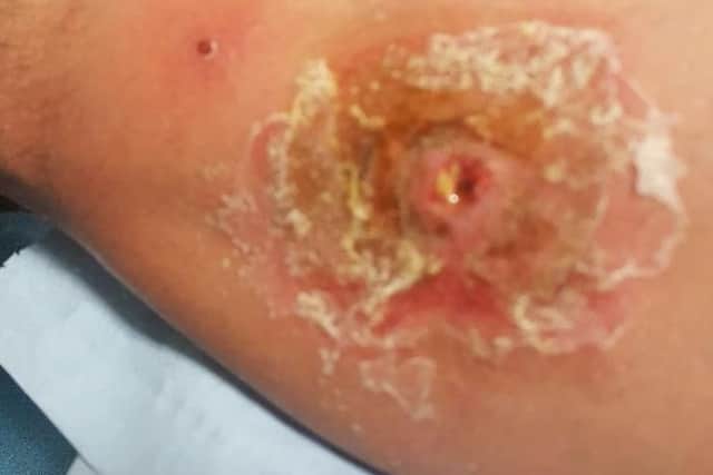 OUCH! The false black widow spider bite