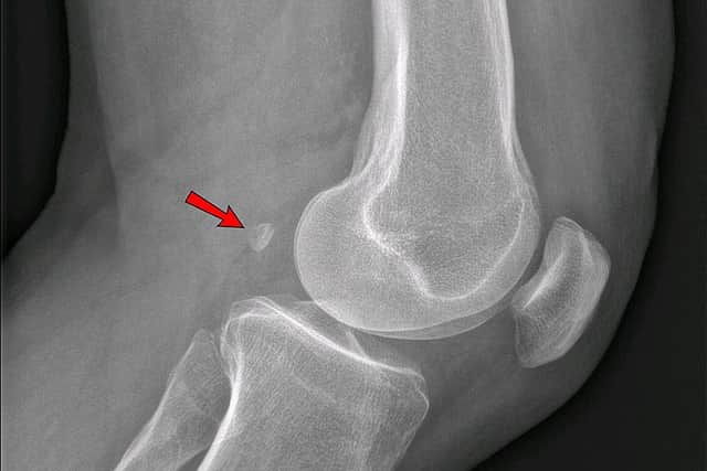 The fabella is found buried in the tendon behind the knee of some people (Image: Jmarchn and Mikael Häggström / Wikimedia Commons)